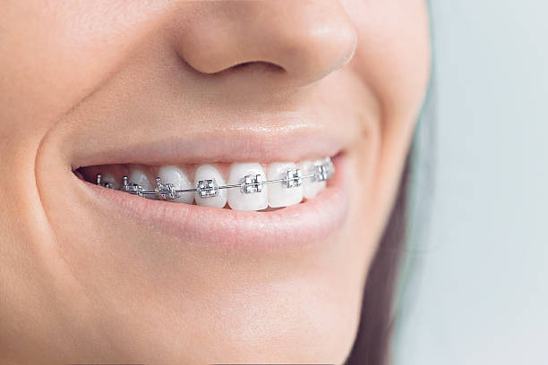 Dental Bonding in Richgrove, CA